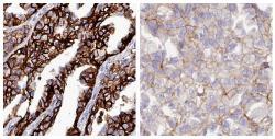 EPCAM_favourable_gene_in_ovarian_cancer_CAB055098.jpg